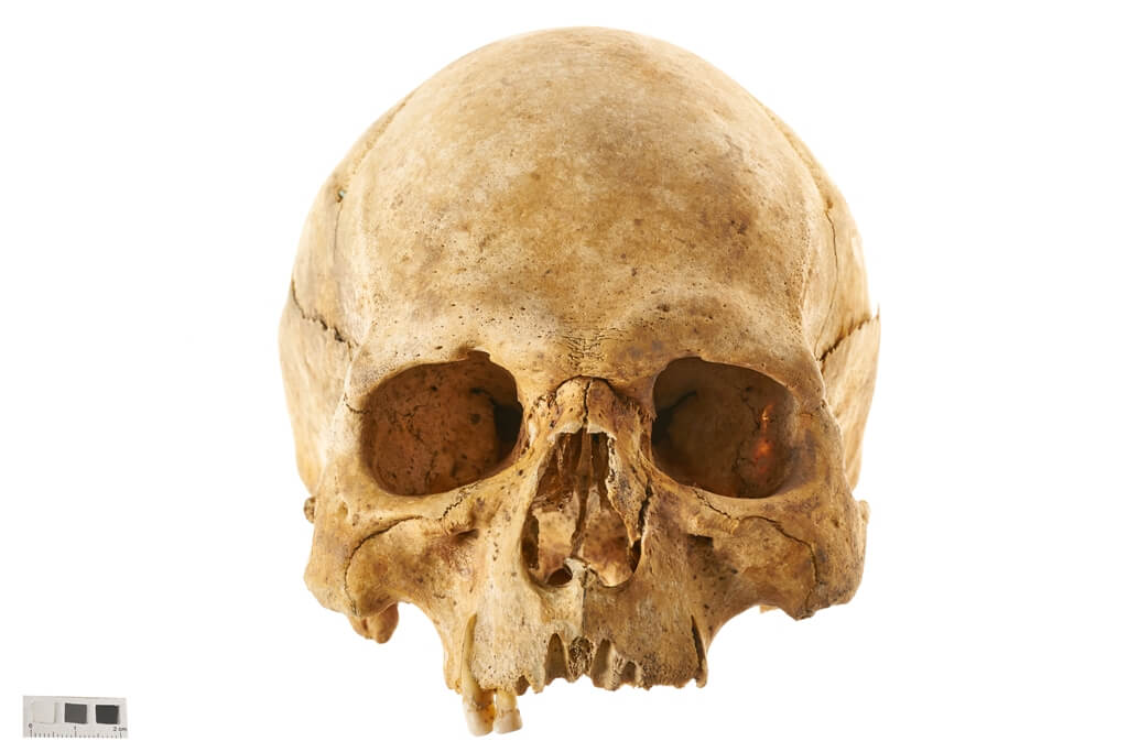 Czaszka mężczyzny, który zmarł w wieku 30–40 lat, ossuarium 2006. Fot. J. Szmit.