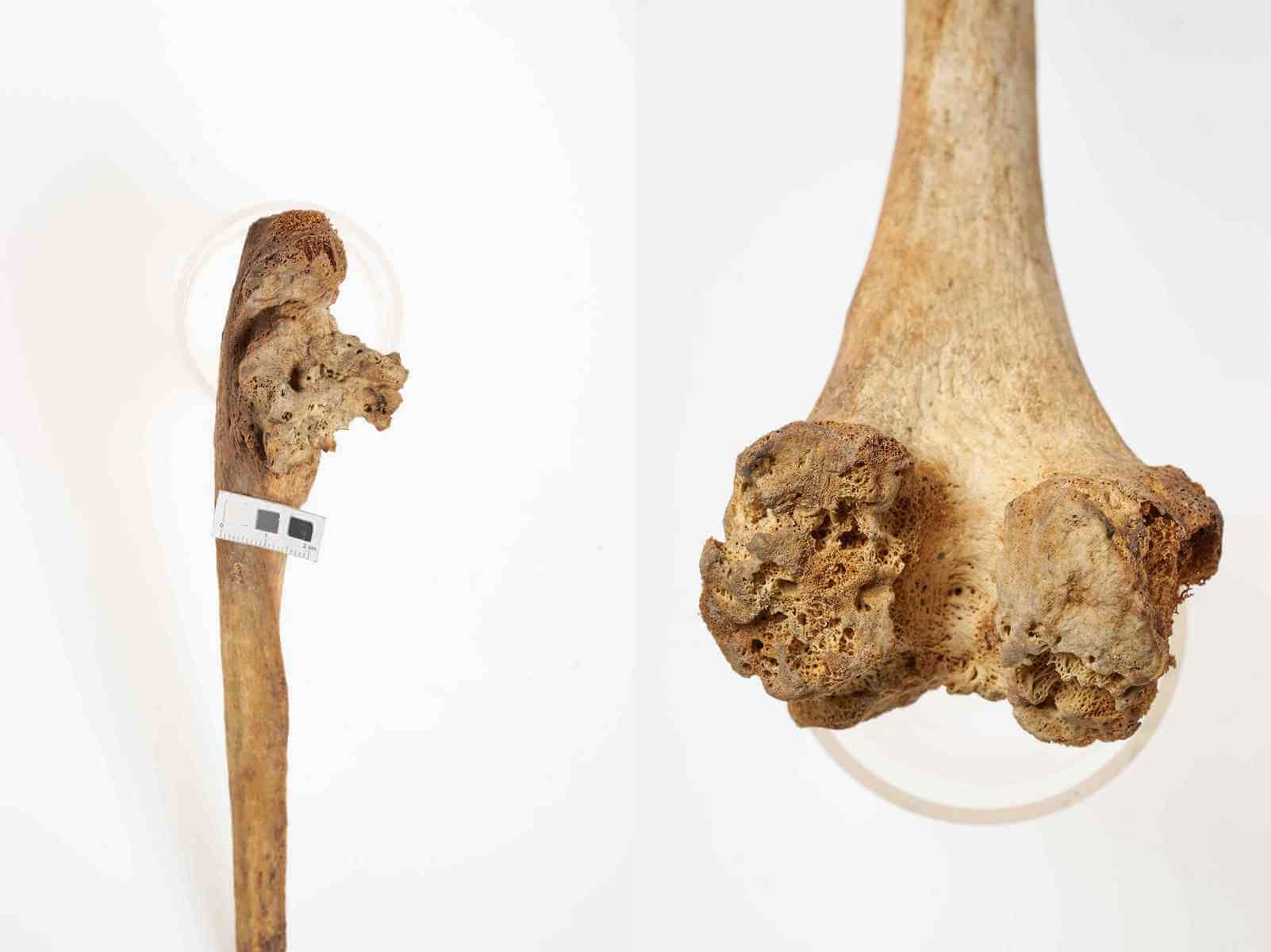 Zniszczenie i silna przebudowa tkanki kostnej w obrębie wyrostków nasady bliższej prawej kości łokciowej, deformacja stawu, osoba dorosła, ossuarium 2046/298/175(4); znaczna destrukcja powierzchni stawowej w obrębie kłykci kości udowej, z dużymi ubytkami w kości podchrzęstnej, osoba dorosła, ossuarium 2006/103/333. Oba przypadki zapalenia kości w połączeniu ze zmianami zwyrodnieniowymi, gruźlica kostno-stawowa(?).