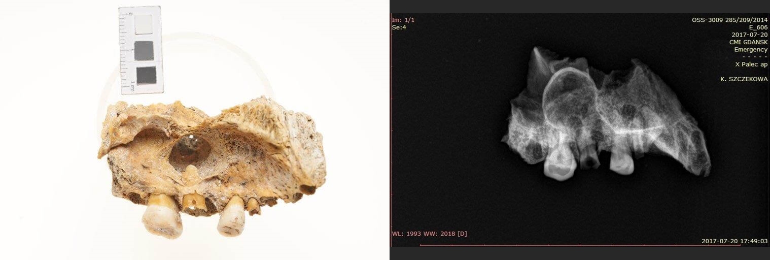 Ślad przetoki w okolicy pierwszego trzonowca, spowodowanej najpewniej ropniem – cystą w okolicy wierzchołka zęba, RTG w projekcji przednio-tylnej: w okolicy korzenia pierwszego zęba trzonowego szczęki ognisko osteolityczne, najprawdopodobniej ślad po ropniu, osoba dorosła, ossuarium 3009/025/209.