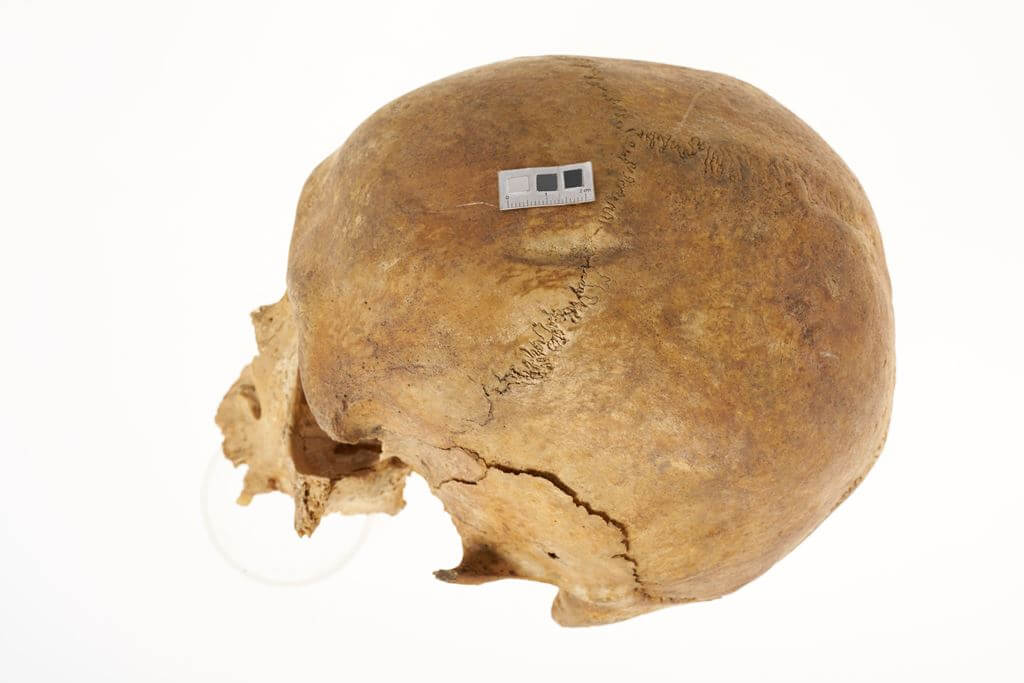 Uraz kości czołowej zadany prawdopodobnie tępym narzędziem, osoba dorosła, ossuarium 2006. Fot. J. Szmit.