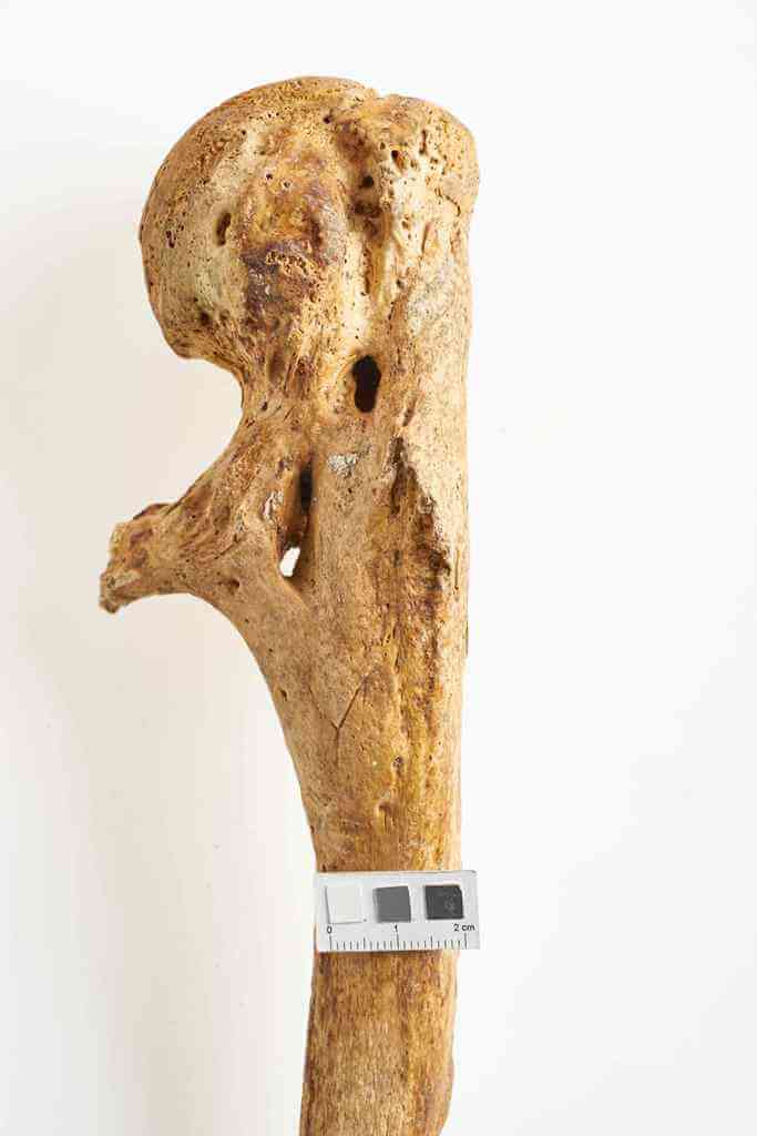 Uraz lewej kości ramiennej z przesunięciem odłamów i kątową deformacją kości, wygojony, osoba dorosła, ossuarium 2006. Fot. J. Szmit.