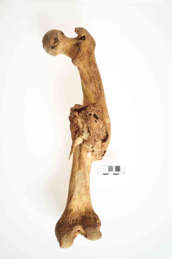 Uraz prawej kości udowej ze znacznym przemieszczeniem odłamów i nieprawidłowym zrostem, który doprowadził do skrócenia trzonu i wystąpienia stanu zapalnego. Uraz mógł być spowodowany upadkiem z wysokości, np. z konia. Osoba dorosła, ossuarium 2006. Fot. J. Szmit.
