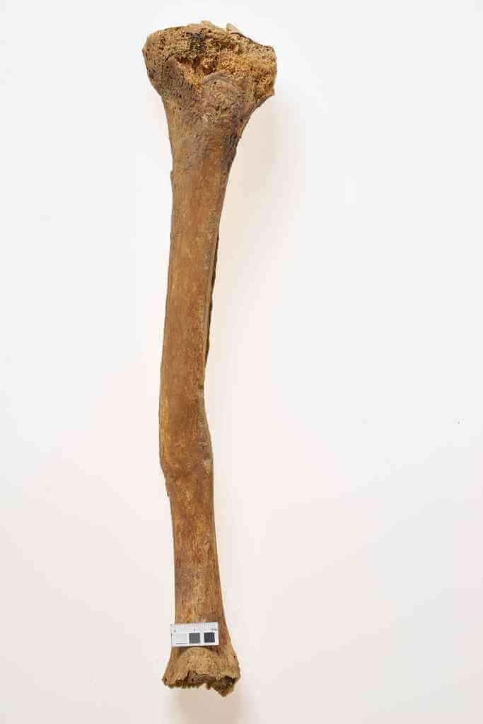 Uraz lewej kości piszczelowej z niewielkim przemieszczeniem się odłamów, wygojony, osoba dorosła, ossuarium 3009. Fot. J. Szmit.