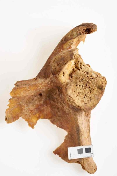 Zniekształcenie wydrążenia stawowego łopatki i obecność wyrośli kostnych (osteofitów) z widocznym przesunięciem powierzchni stawowej w kierunku powierzchni przedniej (żebrowej) łopatki, prawdopodobnie stan po zwichnięciu przednim stawu ramiennego, osoba dorosła, ossuarium 2006/257/42.