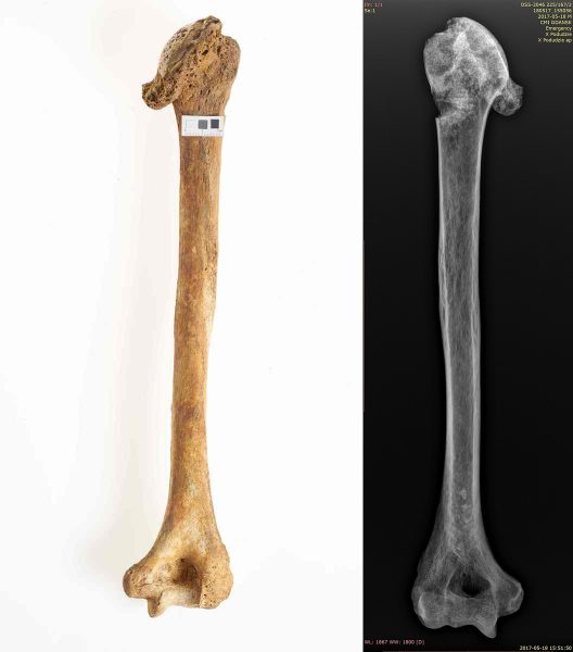 Silna przebudowa i zniszczenie powierzchni stawowej głowy kości ramiennej z widocznymi wyroślami kostnymi (osteofitami), RTG w projekcji przednio-tylnej, głowa kości z widoczną osteofitozą wieńcową i ogniskami sklerotyzacji kości podchrzęstnej. W okolicy dołu dziobiastego części dystalnej kości owalne przejaśnienie ze sklerotyczną obwódką (zmiana torbielowata?), osoba dorosła, ossuarium 2046/225/167(2).