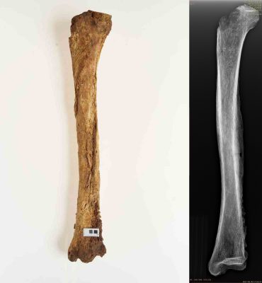 Ślady przewlekłego ropnego zapalenia prawej kości piszczelowej, pogrubienie i zniekształcenie obrysu kości, na tylnej i bocznej powierzchni znaczne nawarstwienia okostnowe i rozsiane ubytki powierzchni zewnętrznej kości, RTG w projekcji przednio-tylnej zatarcie prawidłowej struktury beleczkowania z przebudową sklerotyczno-osteolityczną jamy szpikowej kości piszczelowej. W około 1/2 długości trzonu kości widoczne linijne przejaśnienie, być może powstawanie przetoki ropnej, osoba dorosła, ossuarium 2006/061/305.